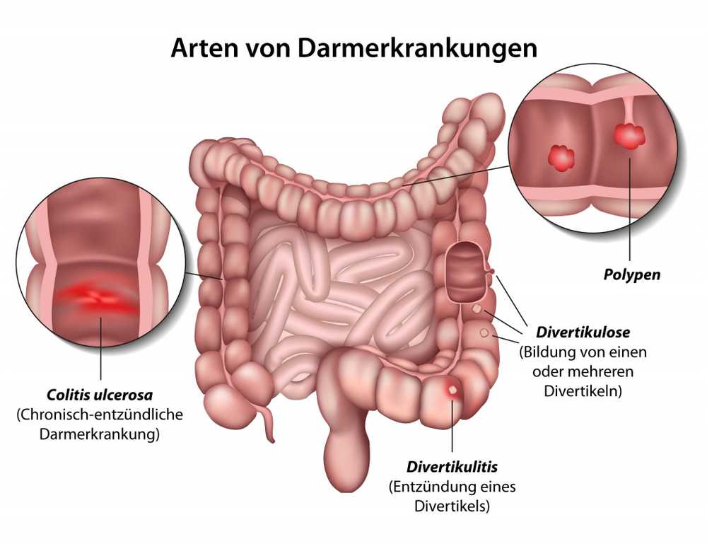 Combatir colitis