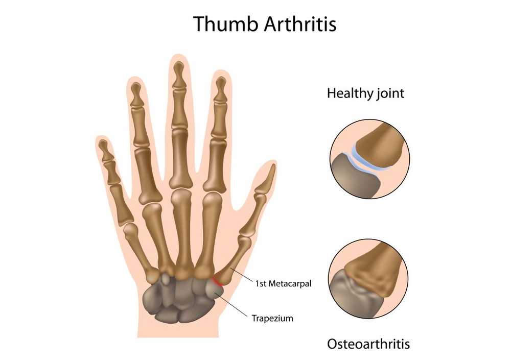 Se puede tener artrosis y artritis a la vez