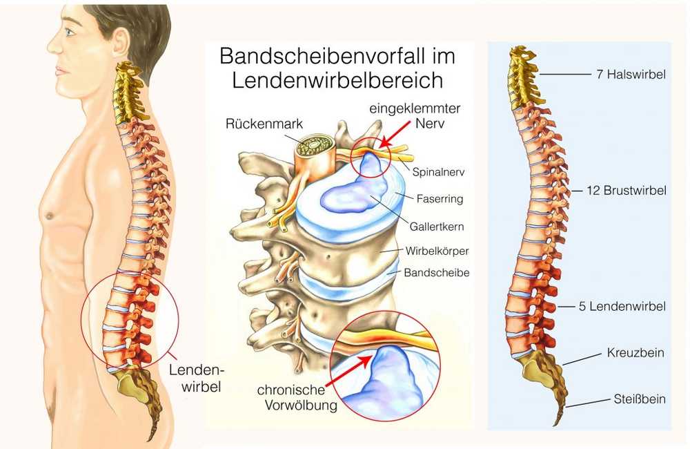 Lendenwirbel gebrochen op Lendenwirbel gebrochen op