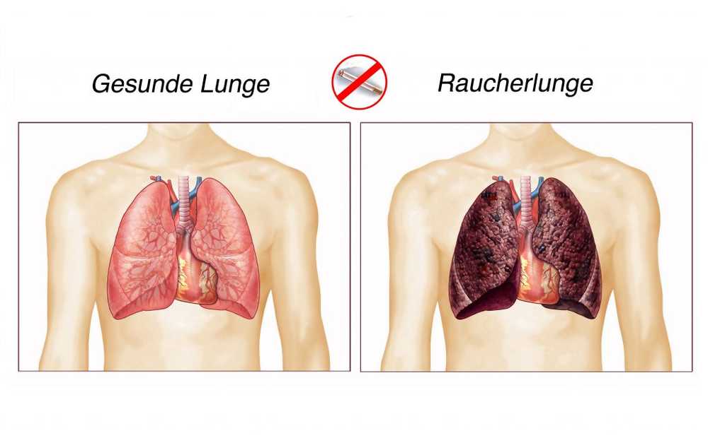 Tre stadier av røyker lunge. 