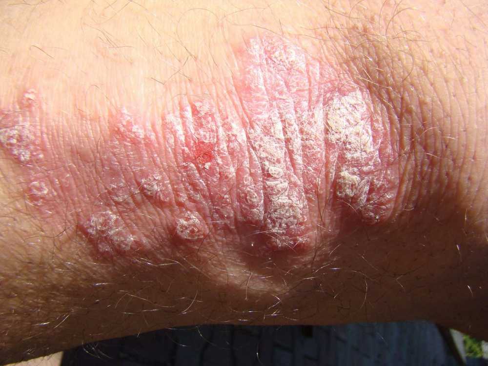 Certain immune cells play a crucial role in psoriasis. 