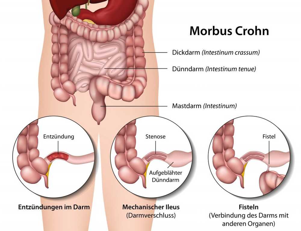 Crohn's disease - New treatment option for chronic intestinal inflamma...